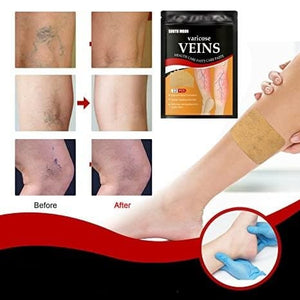 Varicose Veins Treatment Patch DYLINOSHOP